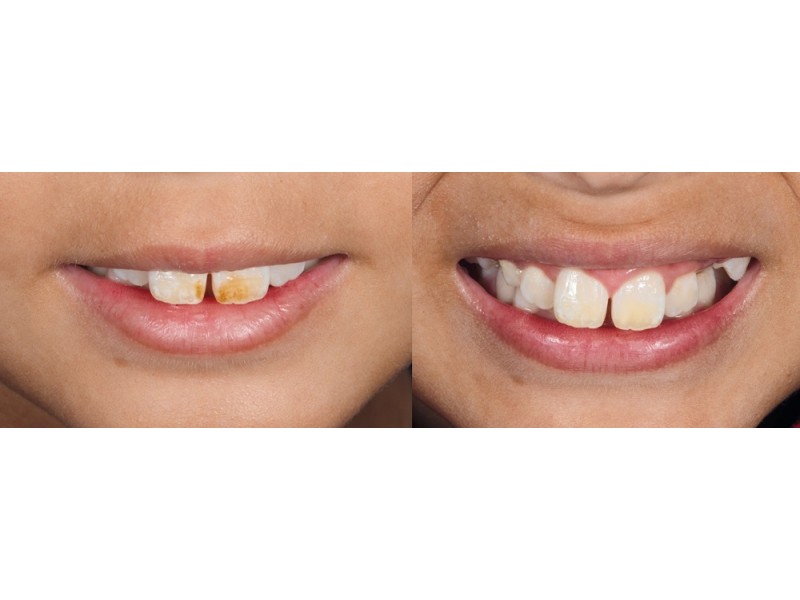 Ultradent - λευκανση - δοντια - Opalustre Οpalustre - πάστα για αφαίρεση δυσχρωμιών και κηλίδων 